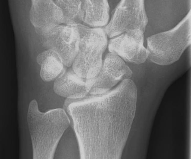 Scaphoid Tuberosity Fracture